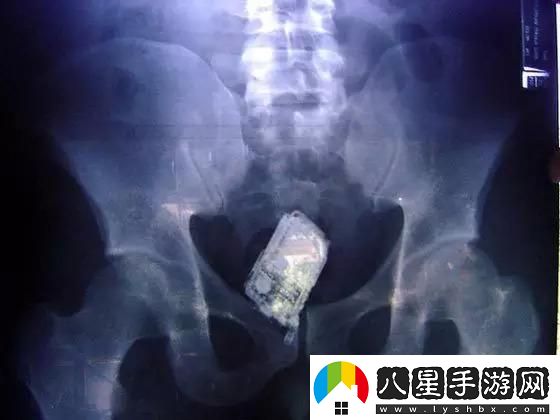 體內(nèi)十年異物